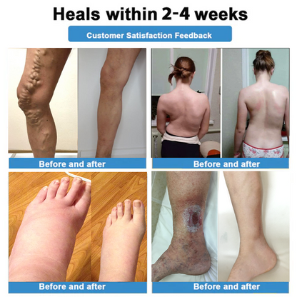 Healrize® 🍃4-in-1 Vein & Joint Nano Microneedle Advanced Therapy Patch🔥Instant Relief, Long-Term Results