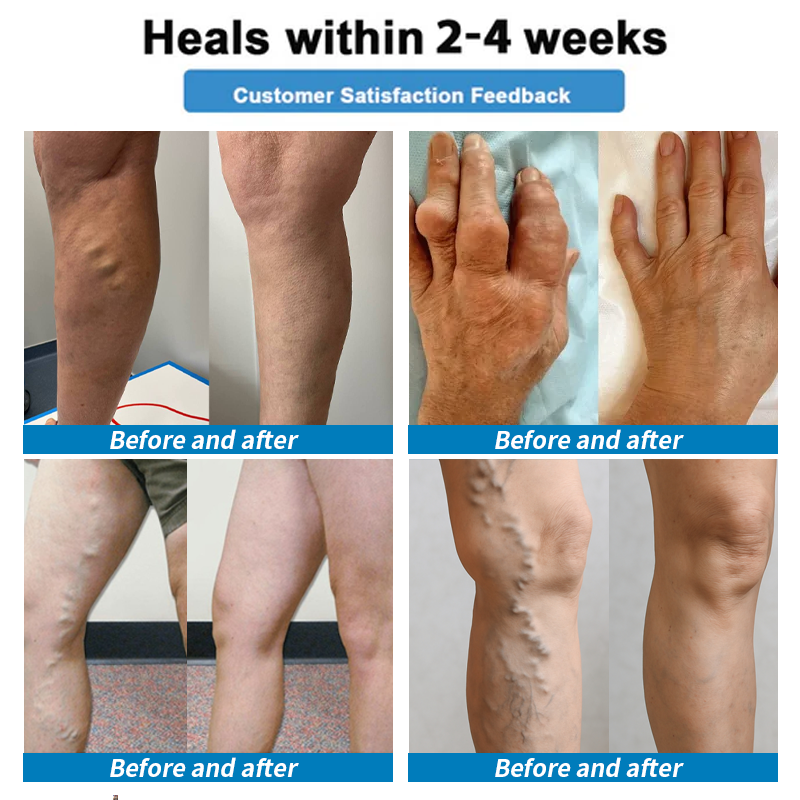 Healrize® 🍃4-in-1 Vein & Joint Nano Microneedle Advanced Therapy Patch🔥Instant Relief, Long-Term Results